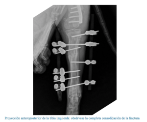 tibia fijador externo